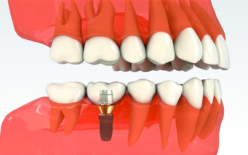 Cấy ghép răng giả có thể được thực hiện thay vì niềng răng đối với người bị mất 2 răng số 6