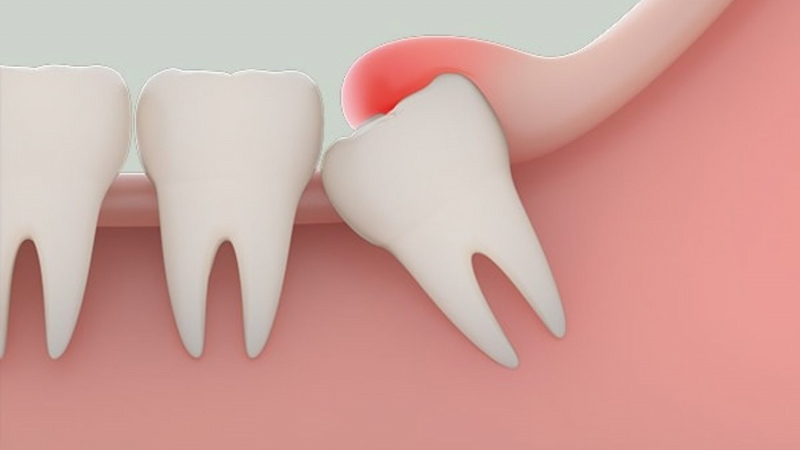Răng khôn thường mọc ở cuối hàm vào giai đoạn 18 đến 25 tuổi