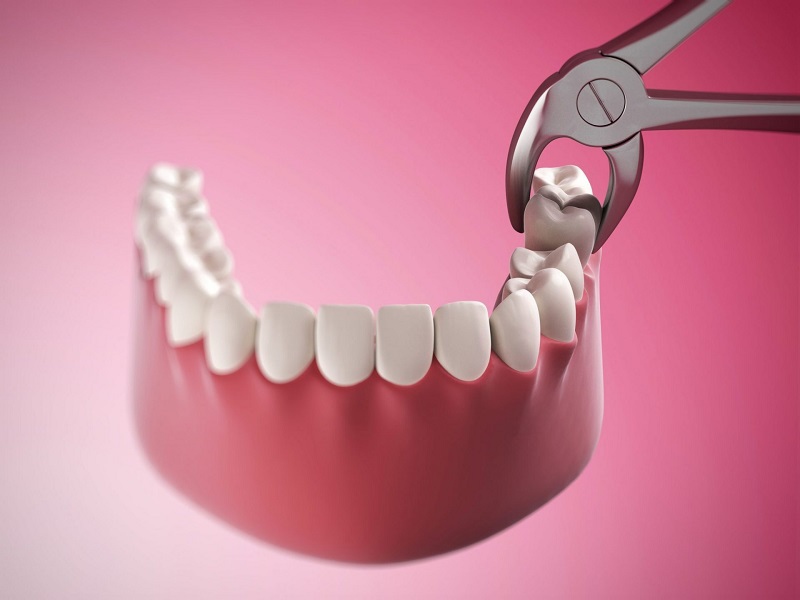 Việc nhổ bỏ răng số 8 cần có sự tư vấn của bác sĩ