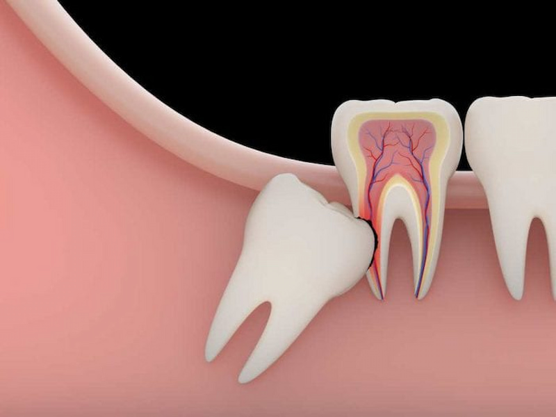 Niềng răng nhổ răng số 8 khi răng mọc ngầm gây ảnh hưởng đến hàm