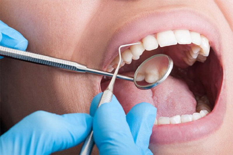 Nhổ răng số 8 thường không gây ra đau đớn