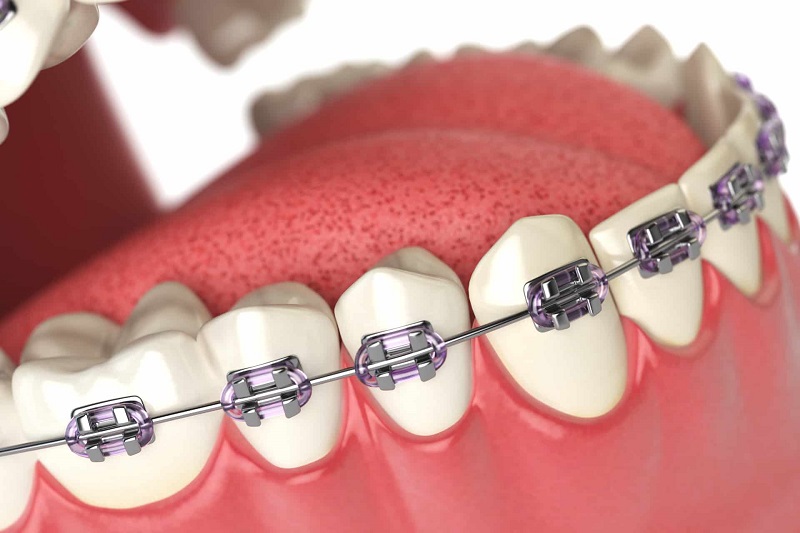 Nhổ răng số 8 giúp việc niềng răng đạt kết quả tốt hơn