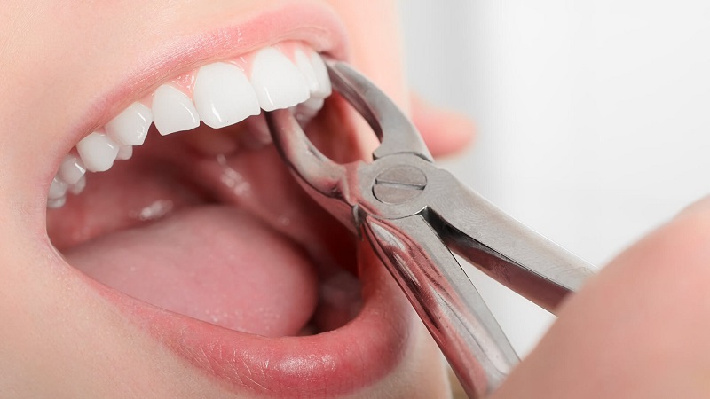 Chi phí nhổ răng số 3 dao động trong khoảng 1 triệu đến hơn 2,5 triệu VNĐ