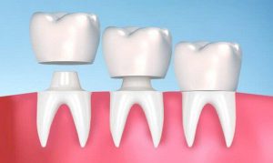 Quy trình trồng răng sứ đúng cách, đạt chuẩn sẽ cho bạn một hàm răng đẹp, chắc khỏe và kéo dài tuổi thọ của răng sứ.