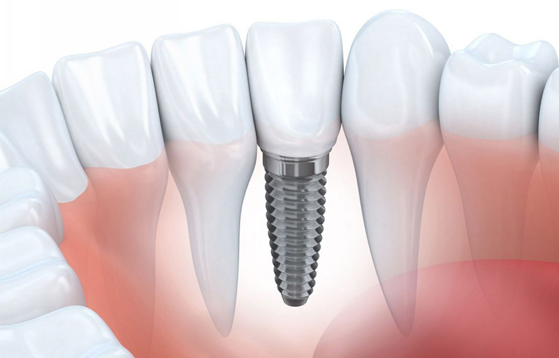 Răng implant giúp cải thiện thẩm mỹ, ăn nhai, tránh tiêu xương hàm...