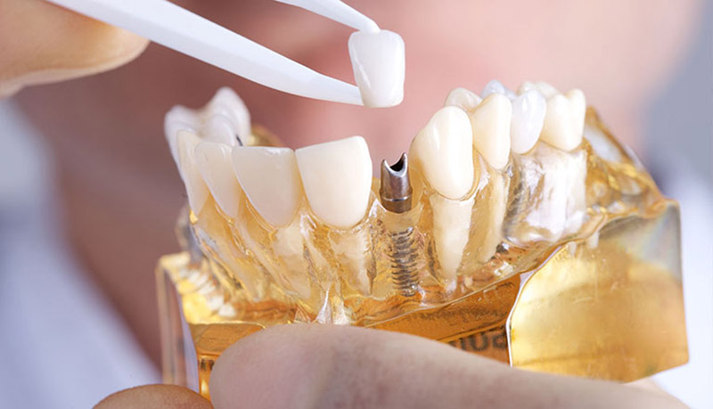 Chi phí trồng răng implant phụ thuộc vào nhiều yếu tố khác nhau