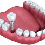 Trồng răng implant là một giải pháp phục hình thẩm mỹ nha khoa hiện đại