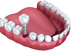 Trồng răng implant là một giải pháp phục hình thẩm mỹ nha khoa hiện đại