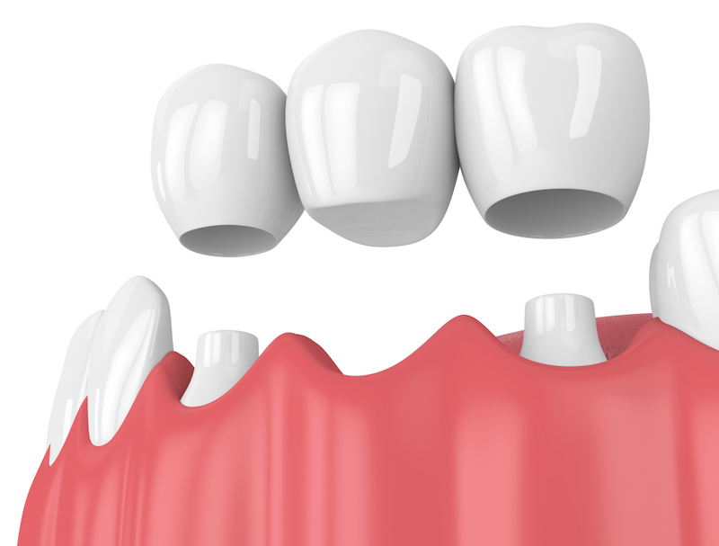 Giải pháp bắc cầu tạo áp lực lên răng thật nên đòi hỏi bác sĩ thực hiện có tay nghề vững vàng