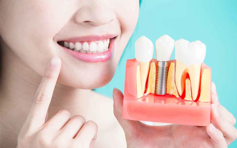 Implant đang là kỹ thuật trồng răng mới nhất, hiện đại nhất