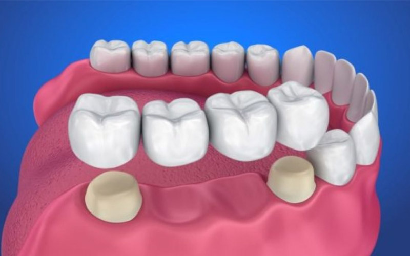 Dưới đây là quy trình trồng răng sứ cố định với những bước cơ bản nhất