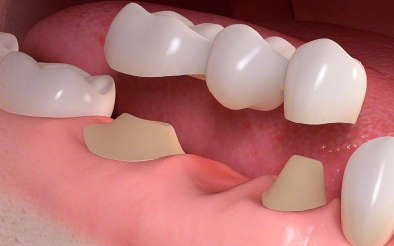 Phương pháp thực hiện ảnh hưởng lớn đến việc trồng răng sứ giá bao nhiêu 1 chiếc