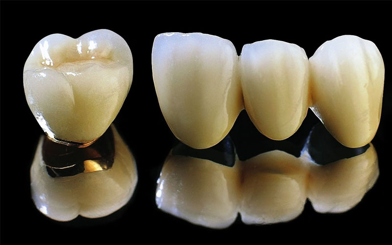 Ưu điểm nổi bật của phương pháp trồng răng sứ Titan