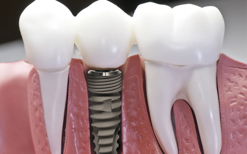 Trong trường hợp các răng bị mất, gãy, trồng răng sứ vĩnh viễn được coi là giải pháp tối ưu nhất