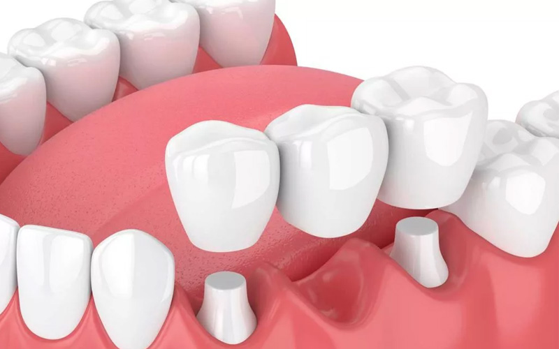 Các phương pháp trồng răng sứ vĩnh viễn phổ biến hiện nay
