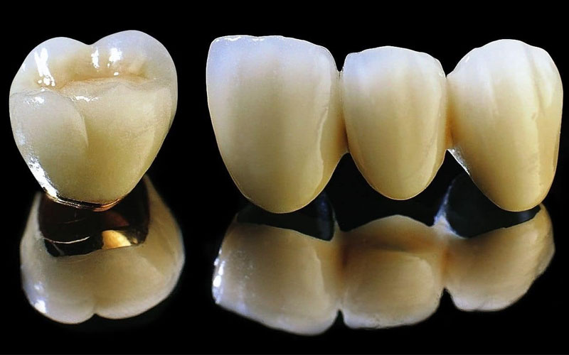 Quy trình thực hiện trồng răng sứ vĩnh viễn đúng chuẩn