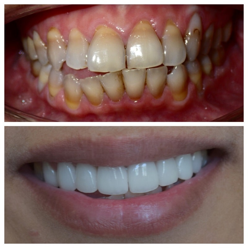  Hình ảnh khách hàng bọc răng sứ tại ViDental