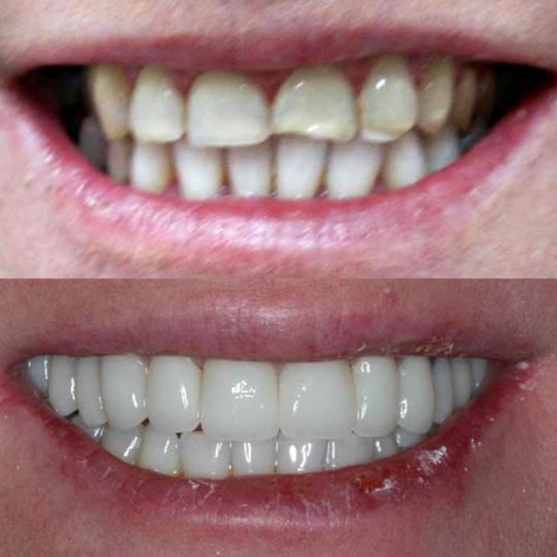  Hình ảnh khách hàng bọc răng sứ tại Vidental