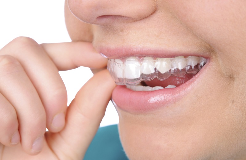 Niềng răng invisalign cũng tồn tại nhiều điểm hạn chế