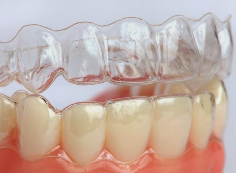 Niềng răng Invisalign dùng khay niềng trong suốt được thiết kế riêng với từng người