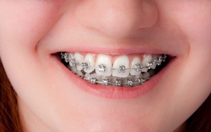 Niềng răng mắc cài kim loại là phương pháp truyền thống nên có giá thành rẻ hơn cả