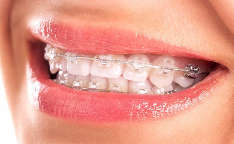 Loại niềng răng này sử dụng dây cung có màu trắng thay vì kim loại như thông thường