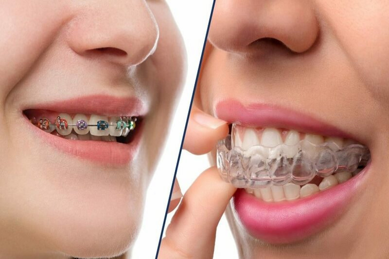 Phương pháp kỹ thuật niềng răng có ảnh hưởng không nhỏ đến chi phí cuối cùng
