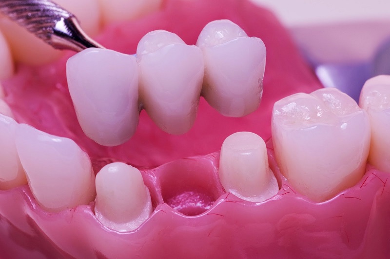 Giá phục hình răng đã mất bằng kỹ thuật bắc cầu răng sứ thấp hơn so với cấy ghép implant