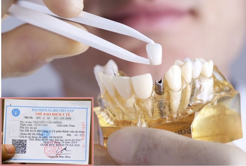 Trồng răng có được hưởng bảo hiểm y tế không là vấn đề được nhiều người quan tâm