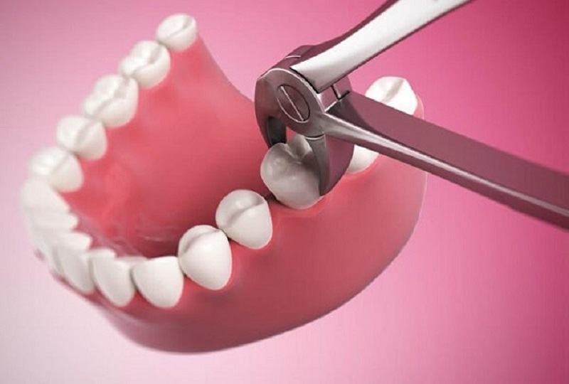 Sau khi nhổ răng bạn nên trồng răng mới để tránh làm ảnh hưởng đến hoạt động nhai nuốt