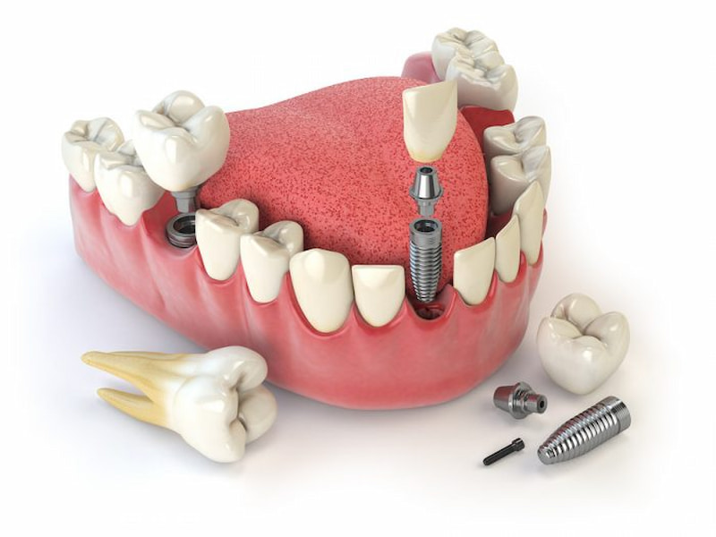 Nhổ răng bao lâu thì trồng răng giả là vấn đề phụ thuộc vào nhiều yếu tố