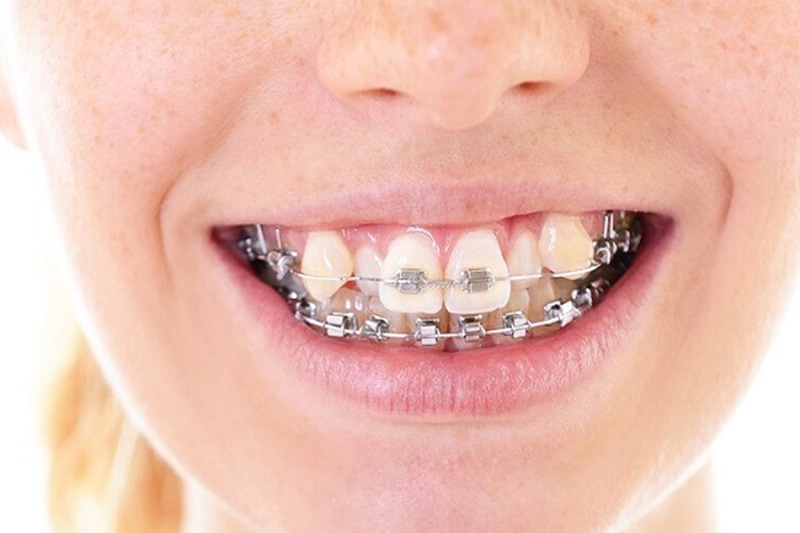 Hiện nay có rất nhiều phương pháp niềng răng giúp bạn giữ lại răng khểnh