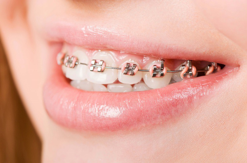 Niềng răng hô hàm trên giúp bạn có được hàm răng đều, đẹp hơn