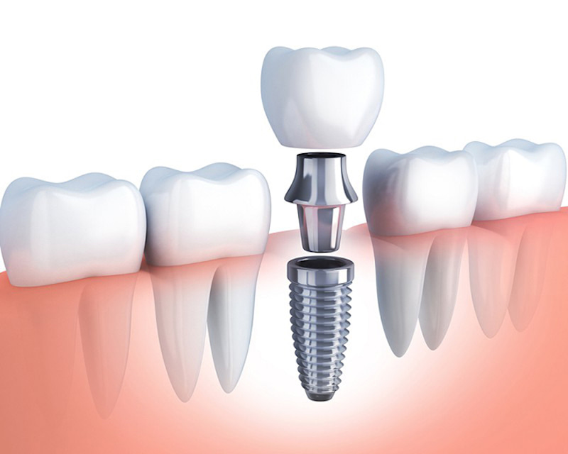 Trồng răng giả hiện nay đang là một giải pháp tốt để phục hình thẩm mỹ răng đã mất 