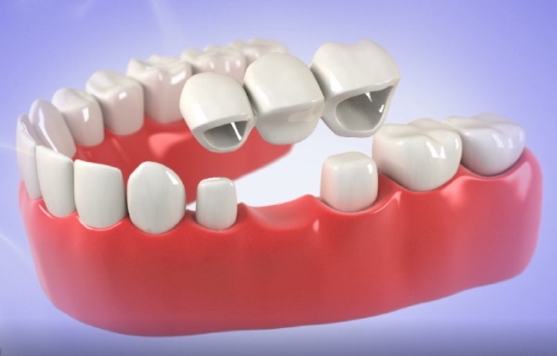 Cầu răng sứ đòi hỏi hai chiếc răng làm trụ ở hai bên răng đã mất phải chắc khỏe