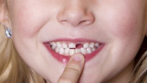 Chi phí trồng răng cửa phụ thuộc vào nhiều yếu tố khác nhau