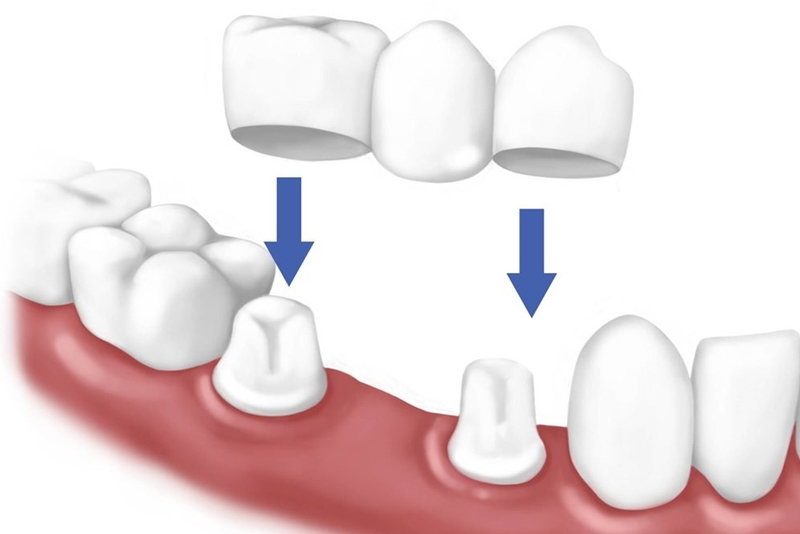 Phương pháp làm cầu răng sứ tác động rất ít đến răng thật nên hạn chế tình trạng đau nhức