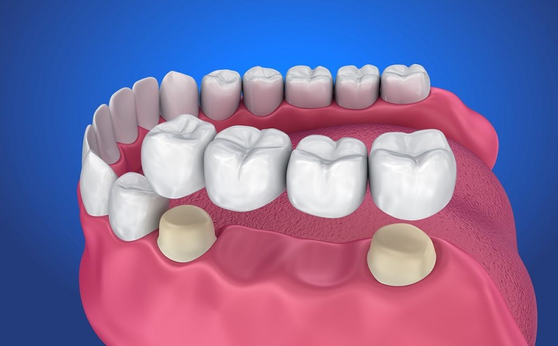 Phương pháp cầu răng sứ sử dụng dải răng sứ gồm ít nhất 3 mão răng