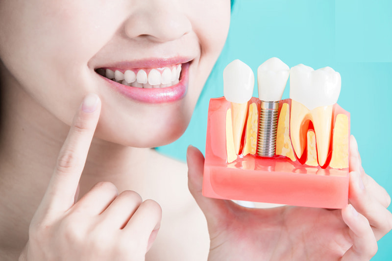 Bạn nên lựa chọn cấy ghép Implant khi bị mất răng để đảm bảo hiệu quả tốt nhất