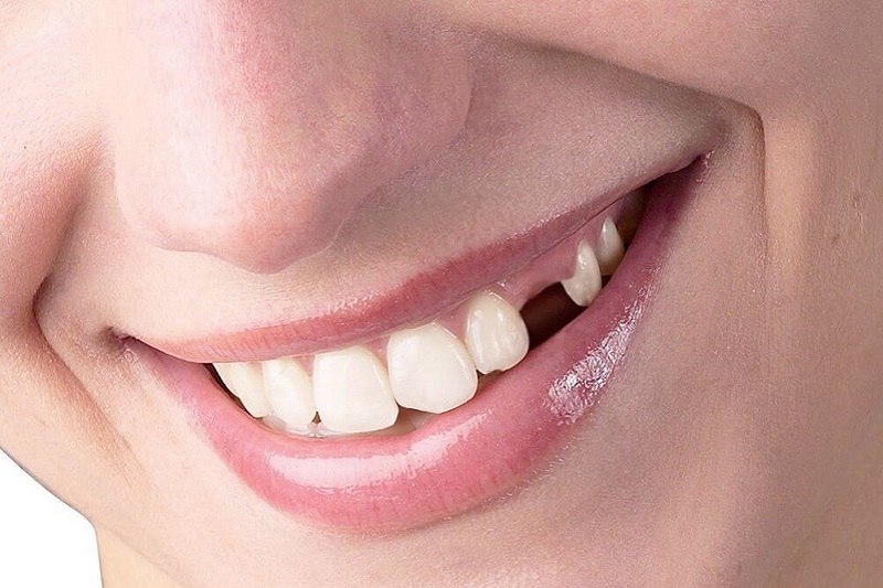 Những người mất răng không quá lâu không nên trồng răng giả cố định