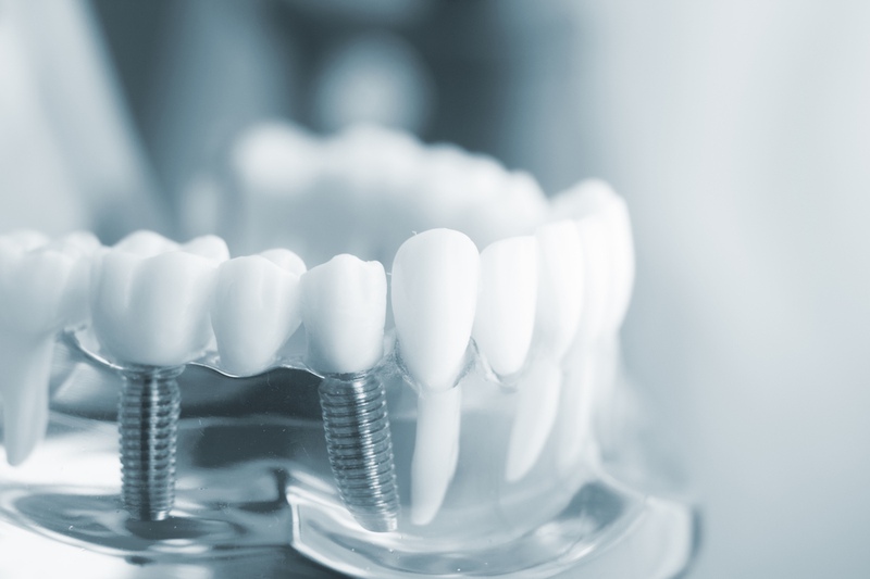 Trồng răng giả cố định Implant có chi phí cao hơn những phương pháp khác