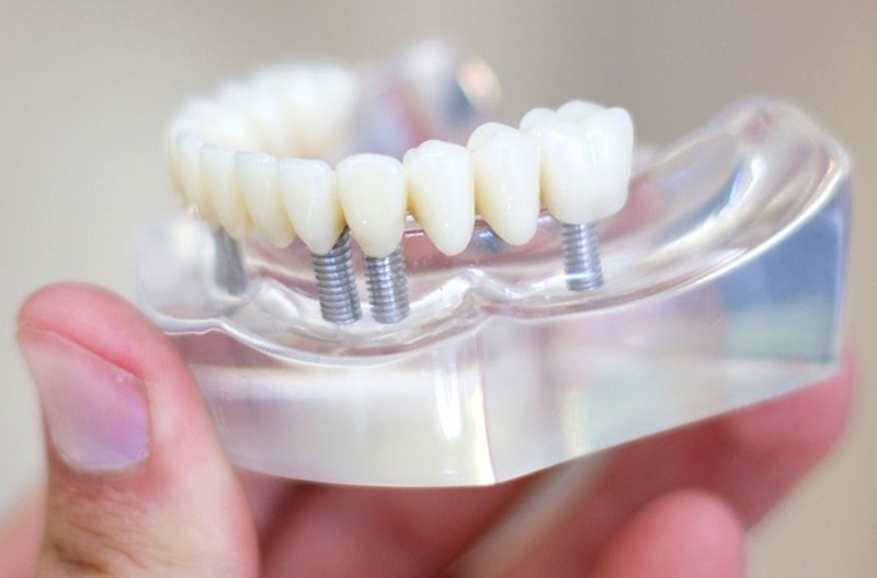 Trồng răng giả mất bao lâu là vấn đề được rất nhiều người thắc mắc đặt ra