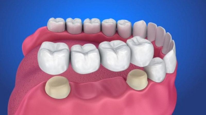 Trồng răng hàm bằng cầu răng sứ giúp cải thiện đáng kể khả năng nhai