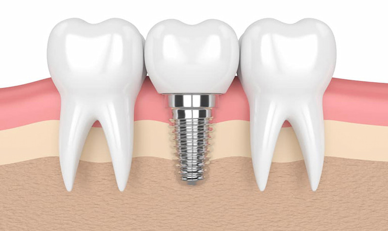 Trồng răng hàm là phương pháp phục hình phổ biến hiện nay