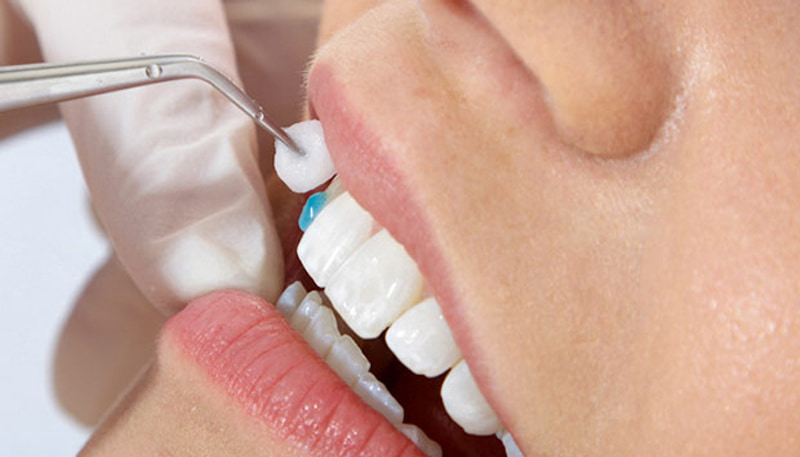 Áp dụng phương pháp làm cầu răng sứ mang đến tính thẩm mỹ cao với độ bền tương đối