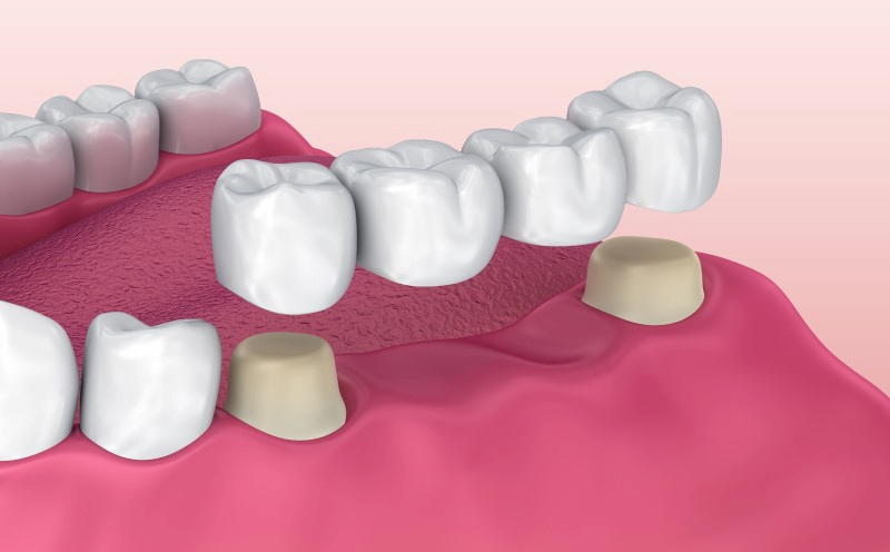 Trồng răng số 7 bằng cấu sứ là phương pháp được không ít người lựa chọn
