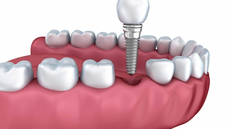 Trồng răng implant là phương pháp hiện đại và tốt nhất hiện nay