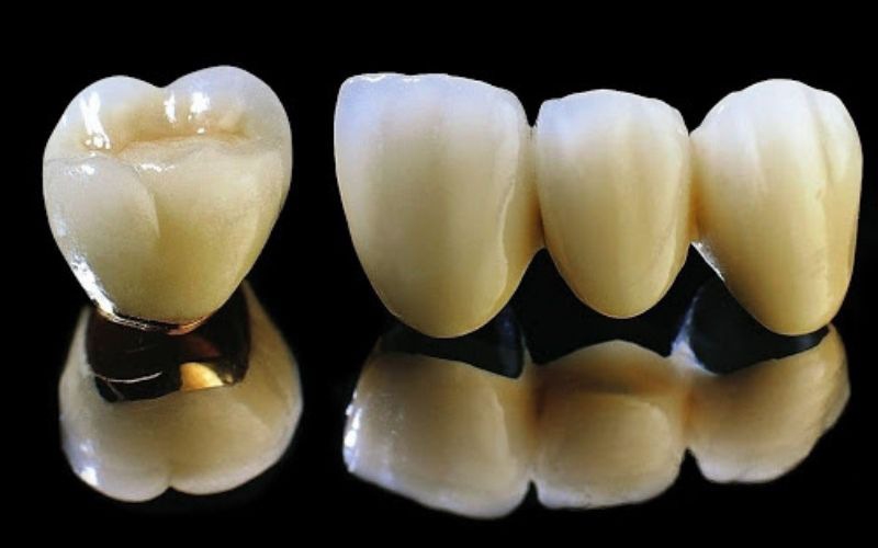 Răng sứ kim loại thường có chi phí rẻ, độ cứng tốt