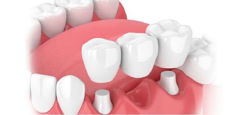 Sự ra đời của răng toàn sứ Emax được xem là bước ngoặt lớn trong lĩnh vực thẩm mỹ nha khoa