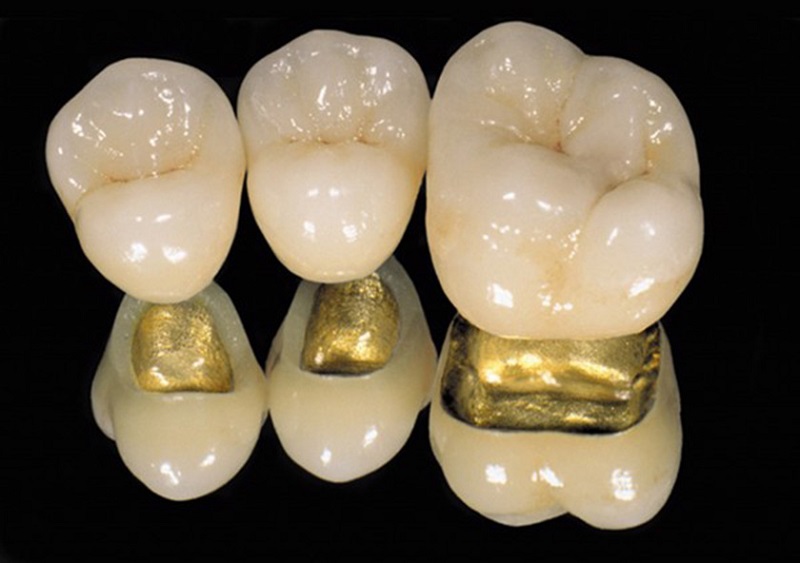 Răng sứ kim loại đá quý được nhiều người đánh giá cao về độ bền, đẹp